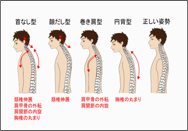 猫背 イラスト 男性  首なし型   顔だし型  巻き型  円背型