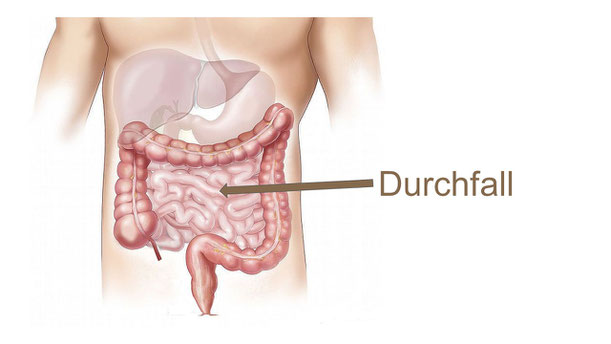 Durchfall Diarrhoe Heinsberg Erkelenz Heilpraktiker NIessen