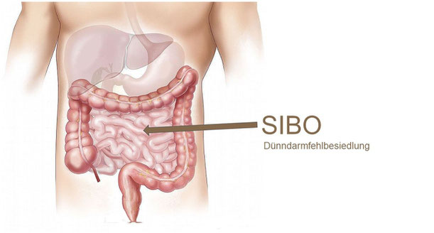 SIBO Dünndarmfehlbesiedlung Heinsberg Erkelenz Niessen