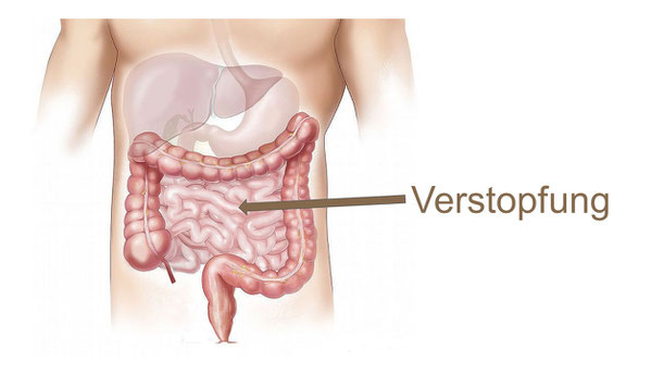 Verstopfung Obstipation Mönchengladbach Heilpraktiker NIessen