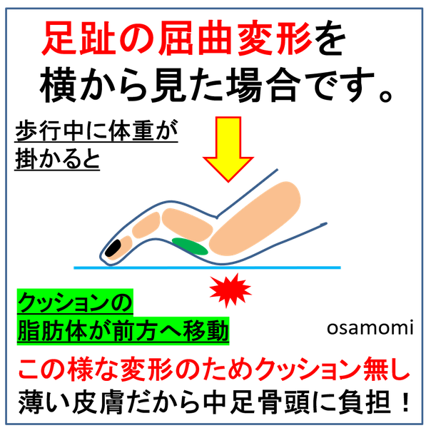 よく見ると足趾が曲がってる 足趾の屈曲変形の足は 中足骨頭部痛やタコが出来ます 昭島市のオサモミ整体院は 足ケアのプロフェッショナル 外反母趾 膝痛 タコ魚の目専門 競歩技術を取り入れたウォーキング教室を開催 日常生活動作を改善し痛い 辛いを解消 よく見ると足趾が曲がってる 足趾の屈曲変形の足は 中足骨頭部痛やタコが出来ます 昭島市のオサモミ整体院は 足ケアのプロフェッショナル 外反母趾 膝痛 タコ魚の目専門 競歩技術を取り入れたウォーキング教室を開催 日常生活動作を改善し痛い 辛いを解消