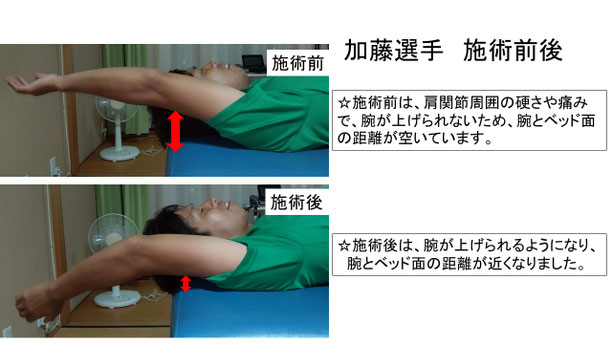肩関節の痛み　姿勢　肩甲骨　肩甲骨痛み　背中の痛み　野球肩の原因　野球肩原因　野球肩治し方　野球肩体操　野球肩ストレッチ　野球　野球肩　肩が痛い　ピッチャー　リトルリーガーズショルダー　腱板損傷　投球傷害　水泳　競泳　腰痛　分離症　分離すべり症　水泳肩スイマーズショルダー　水泳肩　スイマーズショルダー治療　スイマーズショルダー治るのか　岐阜　岐阜市　岐阜市茜部　岐阜市東鶉　岐阜市南鶉　岐阜市中鶉　岐阜市柳津町　羽島市　羽島郡　笠松町　岐南町　茜部　鶉　東鶉　中鶉　南鶉　柳津　笠松　