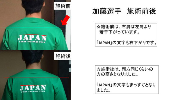 肩関節の痛み　姿勢　肩甲骨　肩甲骨痛み　背中の痛み　野球肩の原因　野球肩原因　野球肩治し方　野球肩体操　野球肩ストレッチ　野球　野球肩　肩が痛い　ピッチャー　リトルリーガーズショルダー　腱板損傷　投球傷害　水泳　競泳　腰痛　分離症　分離すべり症　水泳肩スイマーズショルダー　水泳肩　スイマーズショルダー治療　スイマーズショルダー治るのか　岐阜　岐阜市　岐阜市茜部　岐阜市東鶉　岐阜市南鶉　岐阜市中鶉　岐阜市柳津町　羽島市　羽島郡　笠松町　岐南町　茜部　鶉　東鶉　中鶉　南鶉　柳津　笠松　