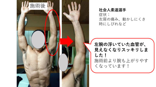 肩関節の痛み 姿勢 肩甲骨 肩甲骨痛み 背中の痛み 野球肩の原因 野球肩原因 野球肩治し方 野球肩体操 野球肩ストレッチ 野球 野球肩 肩が痛い ピッチャー リトルリーガーズショルダー 腱板損傷 投球傷害 水泳 競泳 腰痛 分離症 分離すべり症 水泳肩スイマーズショルダー 水泳肩 スイマーズショルダー治療 スイマーズショルダー治るのか 岐阜 岐阜市 岐阜市茜部 岐阜市東鶉 岐阜市南鶉 岐阜市中鶉 岐阜市柳津町 羽島市 羽島郡 笠松町 岐南町 茜部 鶉 東鶉 中鶉 南鶉 柳津 笠松