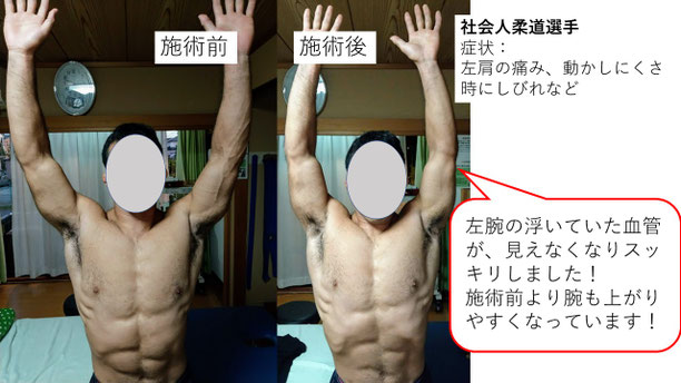 肩関節の痛み 姿勢 肩甲骨 肩甲骨痛み 背中の痛み 野球肩の原因 野球肩原因 野球肩治し方 野球肩体操 野球肩ストレッチ 野球 野球肩 肩が痛い ピッチャー リトルリーガーズショルダー 腱板損傷 投球傷害 水泳 競泳 腰痛 分離症 分離すべり症 水泳肩スイマーズショルダー 水泳肩 スイマーズショルダー治療 スイマーズショルダー治るのか 岐阜 岐阜市 岐阜市茜部 岐阜市東鶉 岐阜市南鶉 岐阜市中鶉 岐阜市柳津町 羽島市 羽島郡 笠松町 岐南町 茜部 鶉 東鶉 中鶉 南鶉 柳津 笠松