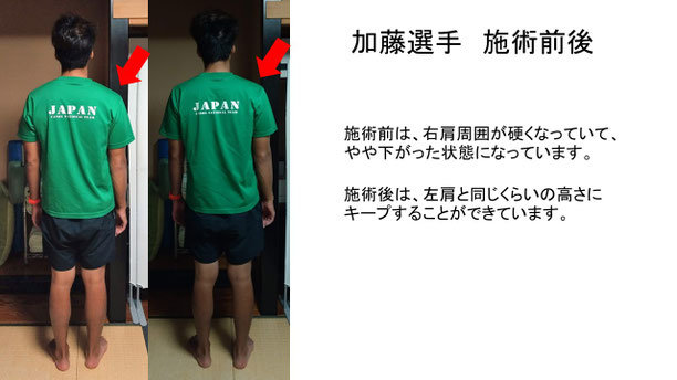 肩関節の痛み　姿勢　肩甲骨　肩甲骨痛み　背中の痛み　野球肩の原因　野球肩原因　野球肩治し方　野球肩体操　野球肩ストレッチ　野球　野球肩　肩が痛い　ピッチャー　リトルリーガーズショルダー　腱板損傷　投球傷害　水泳　競泳　腰痛　分離症　分離すべり症　水泳肩スイマーズショルダー　水泳肩　スイマーズショルダー治療　スイマーズショルダー治るのか　岐阜　岐阜市　岐阜市茜部　岐阜市東鶉　岐阜市南鶉　岐阜市中鶉　岐阜市柳津町　羽島市　羽島郡　笠松町　岐南町　茜部　鶉　東鶉　中鶉　南鶉　柳津　笠松　