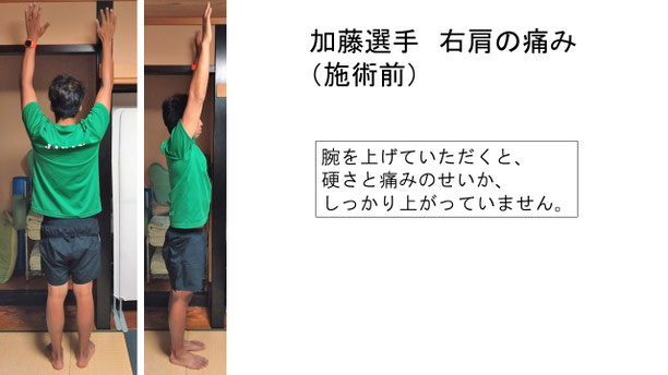 肩関節の痛み　姿勢　肩甲骨　肩甲骨痛み　背中の痛み　野球肩の原因　野球肩原因　野球肩治し方　野球肩体操　野球肩ストレッチ　野球　野球肩　肩が痛い　ピッチャー　リトルリーガーズショルダー　腱板損傷　投球傷害　水泳　競泳　腰痛　分離症　分離すべり症　水泳肩スイマーズショルダー　水泳肩　スイマーズショルダー治療　スイマーズショルダー治るのか　岐阜　岐阜市　岐阜市茜部　岐阜市東鶉　岐阜市南鶉　岐阜市中鶉　岐阜市柳津町　羽島市　羽島郡　笠松町　岐南町　茜部　鶉　東鶉　中鶉　南鶉　柳津　笠松　