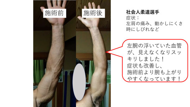 肩関節の痛み 姿勢 肩甲骨 肩甲骨痛み 背中の痛み 野球肩の原因 野球肩原因 野球肩治し方 野球肩体操 野球肩ストレッチ 野球 野球肩 肩が痛い ピッチャー リトルリーガーズショルダー 腱板損傷 投球傷害 水泳 競泳 腰痛 分離症 分離すべり症 水泳肩スイマーズショルダー 水泳肩 スイマーズショルダー治療 スイマーズショルダー治るのか 岐阜 岐阜市 岐阜市茜部 岐阜市東鶉 岐阜市南鶉 岐阜市中鶉 岐阜市柳津町 羽島市 羽島郡 笠松町 岐南町 茜部 鶉 東鶉 中鶉 南鶉 柳津 笠松
