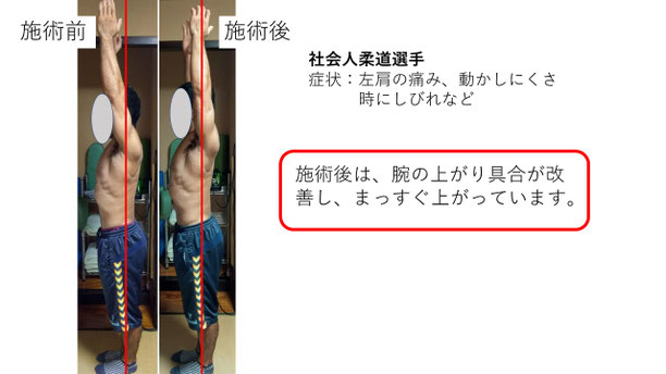 肩関節の痛み 姿勢 肩甲骨 肩甲骨痛み 背中の痛み 野球肩の原因 野球肩原因 野球肩治し方 野球肩体操 野球肩ストレッチ 野球 野球肩 肩が痛い ピッチャー リトルリーガーズショルダー 腱板損傷 投球傷害 水泳 競泳 腰痛 分離症 分離すべり症 水泳肩スイマーズショルダー 水泳肩 スイマーズショルダー治療 スイマーズショルダー治るのか 岐阜 岐阜市 岐阜市茜部 岐阜市東鶉 岐阜市南鶉 岐阜市中鶉 岐阜市柳津町 羽島市 羽島郡 笠松町 岐南町 茜部 鶉 東鶉 中鶉 南鶉 柳津 笠松