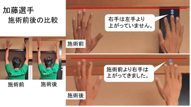 肩関節の痛み　姿勢　肩甲骨　肩甲骨痛み　背中の痛み　野球肩の原因　野球肩原因　野球肩治し方　野球肩体操　野球肩ストレッチ　野球　野球肩　肩が痛い　ピッチャー　リトルリーガーズショルダー　腱板損傷　投球傷害　水泳　競泳　腰痛　分離症　分離すべり症　水泳肩スイマーズショルダー　水泳肩　スイマーズショルダー治療　スイマーズショルダー治るのか　岐阜　岐阜市　岐阜市茜部　岐阜市東鶉　岐阜市南鶉　岐阜市中鶉　岐阜市柳津町　羽島市　羽島郡　笠松町　岐南町　茜部　鶉　東鶉　中鶉　南鶉　柳津　笠松　