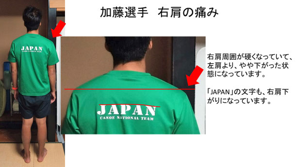 肩関節の痛み　姿勢　肩甲骨　肩甲骨痛み　背中の痛み　野球肩の原因　野球肩原因　野球肩治し方　野球肩体操　野球肩ストレッチ　野球　野球肩　肩が痛い　ピッチャー　リトルリーガーズショルダー　腱板損傷　投球傷害　水泳　競泳　腰痛　分離症　分離すべり症　水泳肩スイマーズショルダー　水泳肩　スイマーズショルダー治療　スイマーズショルダー治るのか　岐阜　岐阜市　岐阜市茜部　岐阜市東鶉　岐阜市南鶉　岐阜市中鶉　岐阜市柳津町　羽島市　羽島郡　笠松町　岐南町　茜部　鶉　東鶉　中鶉　南鶉　柳津　笠松　