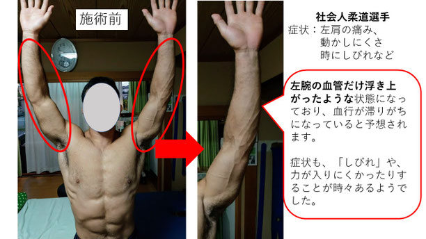 肩関節の痛み 姿勢 肩甲骨 肩甲骨痛み 背中の痛み 野球肩の原因 野球肩原因 野球肩治し方 野球肩体操 野球肩ストレッチ 野球 野球肩 肩が痛い ピッチャー リトルリーガーズショルダー 腱板損傷 投球傷害 水泳 競泳 腰痛 分離症 分離すべり症 水泳肩スイマーズショルダー 水泳肩 スイマーズショルダー治療 スイマーズショルダー治るのか 岐阜 岐阜市 岐阜市茜部 岐阜市東鶉 岐阜市南鶉 岐阜市中鶉 岐阜市柳津町 羽島市 羽島郡 笠松町 岐南町 茜部 鶉 東鶉 中鶉 南鶉 柳津 笠松