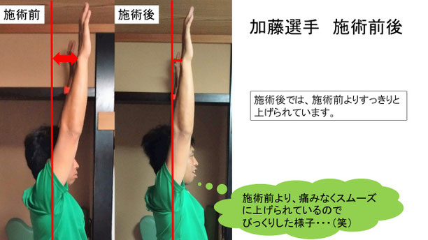 肩関節の痛み　姿勢　肩甲骨　肩甲骨痛み　背中の痛み　野球肩の原因　野球肩原因　野球肩治し方　野球肩体操　野球肩ストレッチ　野球　野球肩　肩が痛い　ピッチャー　リトルリーガーズショルダー　腱板損傷　投球傷害　水泳　競泳　腰痛　分離症　分離すべり症　水泳肩スイマーズショルダー　水泳肩　スイマーズショルダー治療　スイマーズショルダー治るのか　岐阜　岐阜市　岐阜市茜部　岐阜市東鶉　岐阜市南鶉　岐阜市中鶉　岐阜市柳津町　羽島市　羽島郡　笠松町　岐南町　茜部　鶉　東鶉　中鶉　南鶉　柳津　笠松　