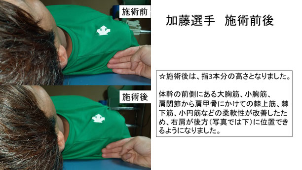 肩関節の痛み　姿勢　肩甲骨　肩甲骨痛み　背中の痛み　野球肩の原因　野球肩原因　野球肩治し方　野球肩体操　野球肩ストレッチ　野球　野球肩　肩が痛い　ピッチャー　リトルリーガーズショルダー　腱板損傷　投球傷害　水泳　競泳　腰痛　分離症　分離すべり症　水泳肩スイマーズショルダー　水泳肩　スイマーズショルダー治療　スイマーズショルダー治るのか　岐阜　岐阜市　岐阜市茜部　岐阜市東鶉　岐阜市南鶉　岐阜市中鶉　岐阜市柳津町　羽島市　羽島郡　笠松町　岐南町　茜部　鶉　東鶉　中鶉　南鶉　柳津　笠松　