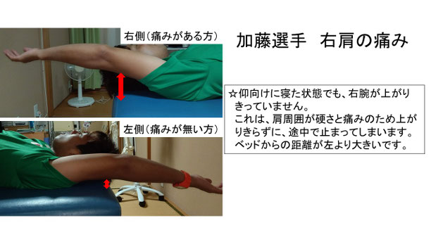 肩関節の痛み　姿勢　肩甲骨　肩甲骨痛み　背中の痛み　野球肩の原因　野球肩原因　野球肩治し方　野球肩体操　野球肩ストレッチ　野球　野球肩　肩が痛い　ピッチャー　リトルリーガーズショルダー　腱板損傷　投球傷害　水泳　競泳　腰痛　分離症　分離すべり症　水泳肩スイマーズショルダー　水泳肩　スイマーズショルダー治療　スイマーズショルダー治るのか　岐阜　岐阜市　岐阜市茜部　岐阜市東鶉　岐阜市南鶉　岐阜市中鶉　岐阜市柳津町　羽島市　羽島郡　笠松町　岐南町　茜部　鶉　東鶉　中鶉　南鶉　柳津　笠松　