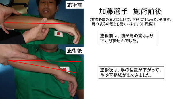 肩関節の痛み　姿勢　肩甲骨　肩甲骨痛み　背中の痛み　野球肩の原因　野球肩原因　野球肩治し方　野球肩体操　野球肩ストレッチ　野球　野球肩　肩が痛い　ピッチャー　リトルリーガーズショルダー　腱板損傷　投球傷害　水泳　競泳　腰痛　分離症　分離すべり症　水泳肩スイマーズショルダー　水泳肩　スイマーズショルダー治療　スイマーズショルダー治るのか　岐阜　岐阜市　岐阜市茜部　岐阜市東鶉　岐阜市南鶉　岐阜市中鶉　岐阜市柳津町　羽島市　羽島郡　笠松町　岐南町　茜部　鶉　東鶉　中鶉　南鶉　柳津　笠松　