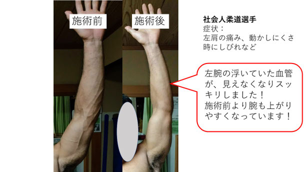 肩関節の痛み 姿勢 肩甲骨 肩甲骨痛み 背中の痛み 野球肩の原因 野球肩原因 野球肩治し方 野球肩体操 野球肩ストレッチ 野球 野球肩 肩が痛い ピッチャー リトルリーガーズショルダー 腱板損傷 投球傷害 水泳 競泳 腰痛 分離症 分離すべり症 水泳肩スイマーズショルダー 水泳肩 スイマーズショルダー治療 スイマーズショルダー治るのか 岐阜 岐阜市 岐阜市茜部 岐阜市東鶉 岐阜市南鶉 岐阜市中鶉 岐阜市柳津町 羽島市 羽島郡 笠松町 岐南町 茜部 鶉 東鶉 中鶉 南鶉 柳津 笠松