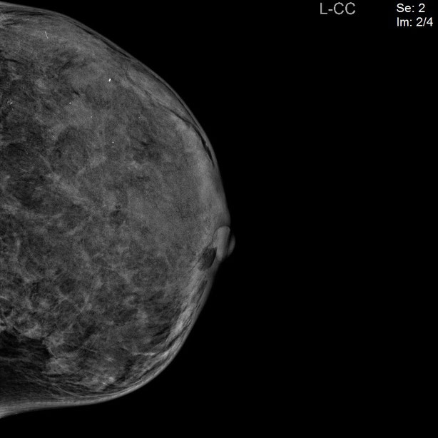 BREAST Imaging internationalradiologys seite!