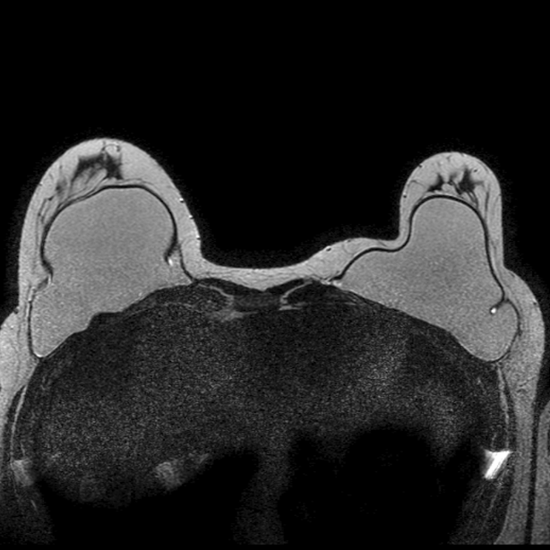 BREAST Imaging internationalradiologys seite!