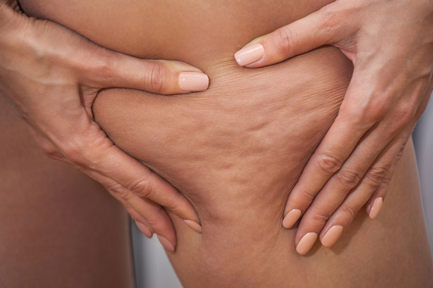 Cellulite Therapie Basel