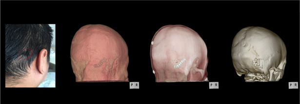 顔が痙攣する顔面痙攣（けいれん）の術後の３D画像（CT）