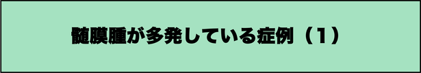 多発性髄膜腫の症例