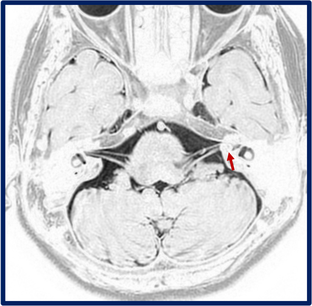 内耳道内に発生した聴神経腫瘍がわかる頭部MRI画像
