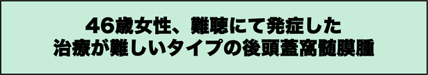 難聴にて発症した手術が難しい後頭蓋窩髄膜腫（斜台錐体部髄膜腫）の４６歳女性の症例