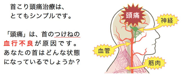 首こり頭痛治療の説明。「頭痛」は首の付け根の血行不良が原因です。あなたの首はどんな状態ですか？愛知県東海市の頭痛専門みらくる整体院。