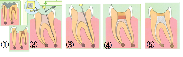 根の治療のやり直し