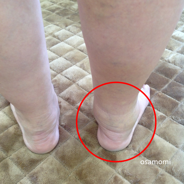 オサモミ整体院 かかと異常 足首痛