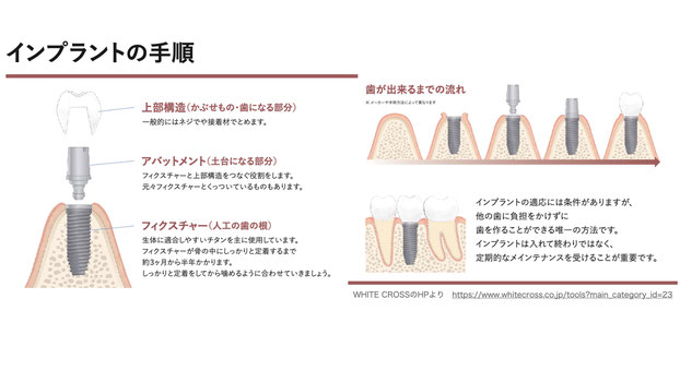 インプラント