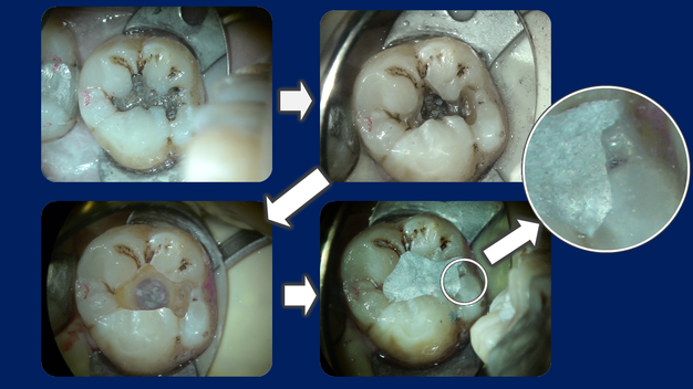 アマルガム充填のステップ