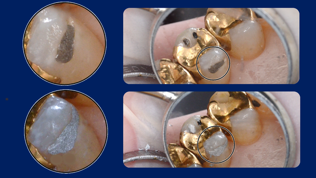 欠けたアマルガムを修復し直し