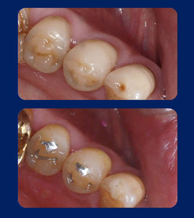 点状の歯の欠けを修復し、機能させることができる強度を持つ