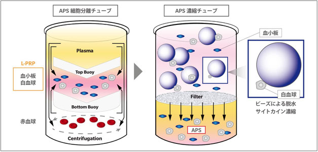 APSの抽出　名戸ヶ谷病院　整形外科　関節治療センター　人工関節　千葉県　柏市