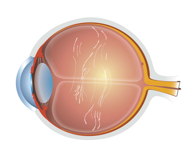 Querschnitt des Auges mit Glaskörpertrübungen, Copyright: Ellex Medical