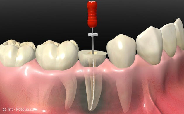 Was ist eine Wurzelbehandlung und wann muss sie gemacht werden?