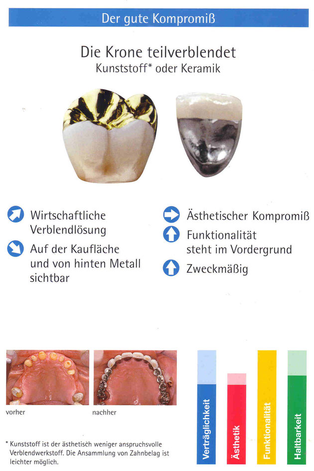 teilverblendete Krone