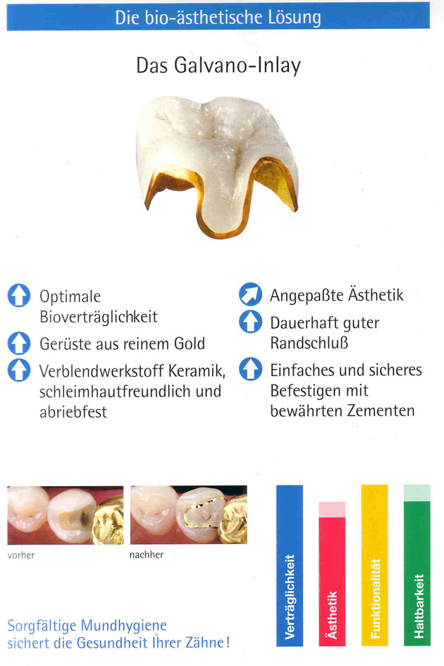 Galvano-Inlay