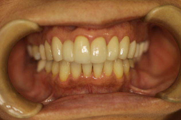 全体的な審美歯科治療
