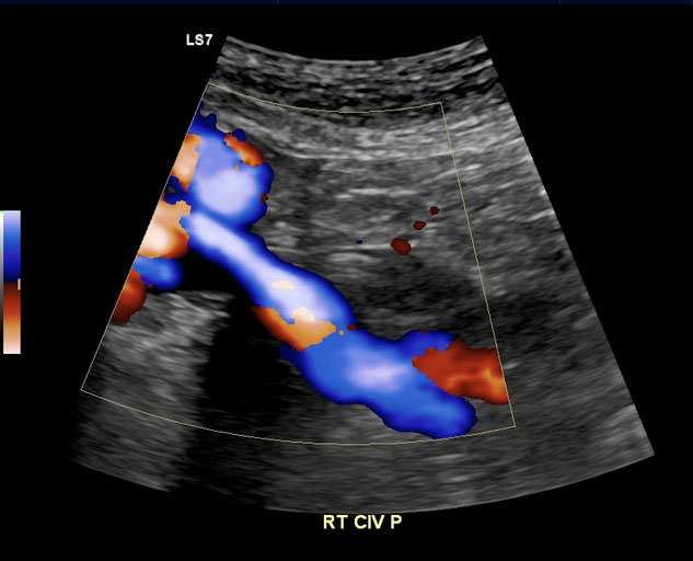 May Thurner Syndrome or left common iliac vein compression causes a proximal obstruction and chronic swelling of the left leg. Nutcracker syndrome is another venous obstructive disorder. 