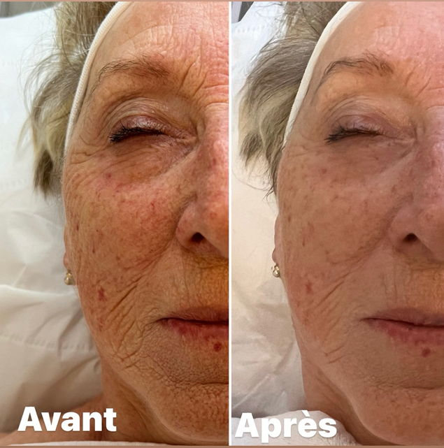 Avant/Après 1 séance microneedlind visage complet: tient unifié et taches pigmentaires atténuées; pore resserrés, peau plus lisse et lumineuse, rides estompées. Effet glow