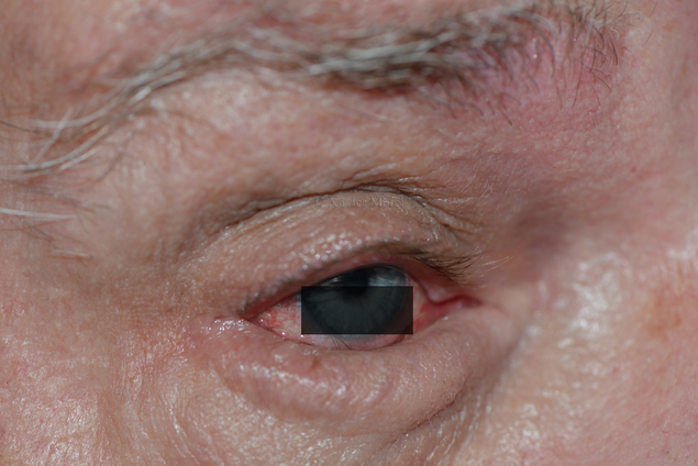 Irritation conjonctivale par le trichiasis