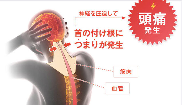 頭痛を引き起こす流れ