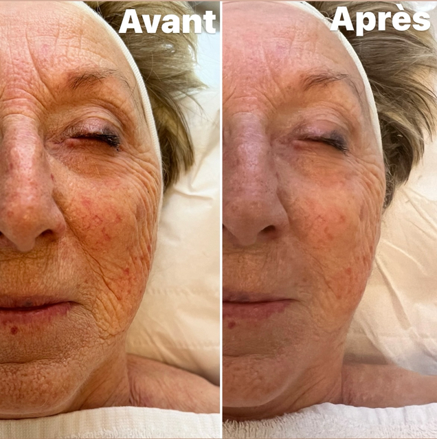 Résultats avant/après d