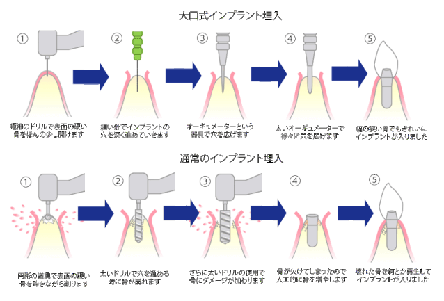 OAM比較