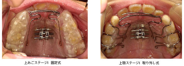 上顎ステージⅠ固定式と取り外し式