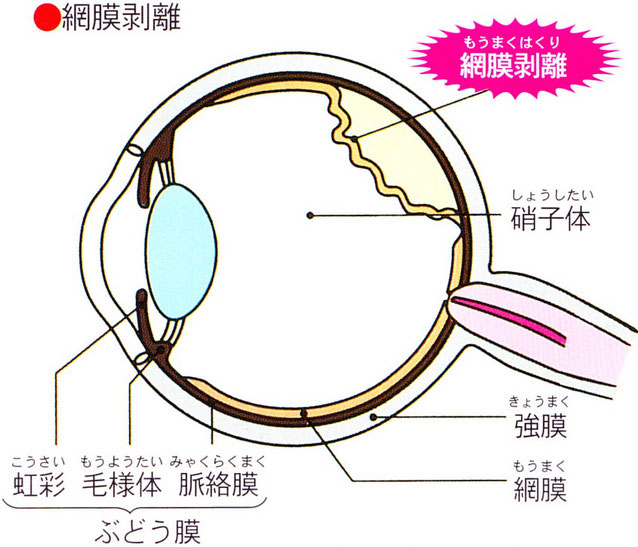 網膜剥離の画像