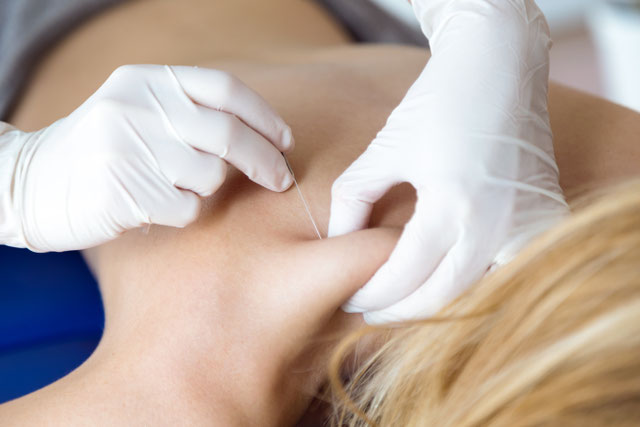 Dry-Needling-Therapie